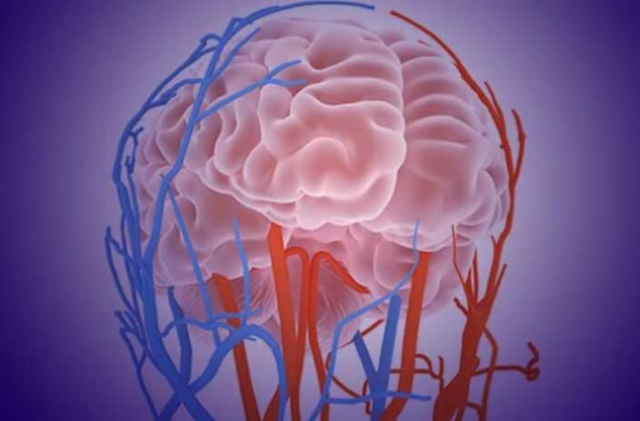 aneurysm brain haemorrhage