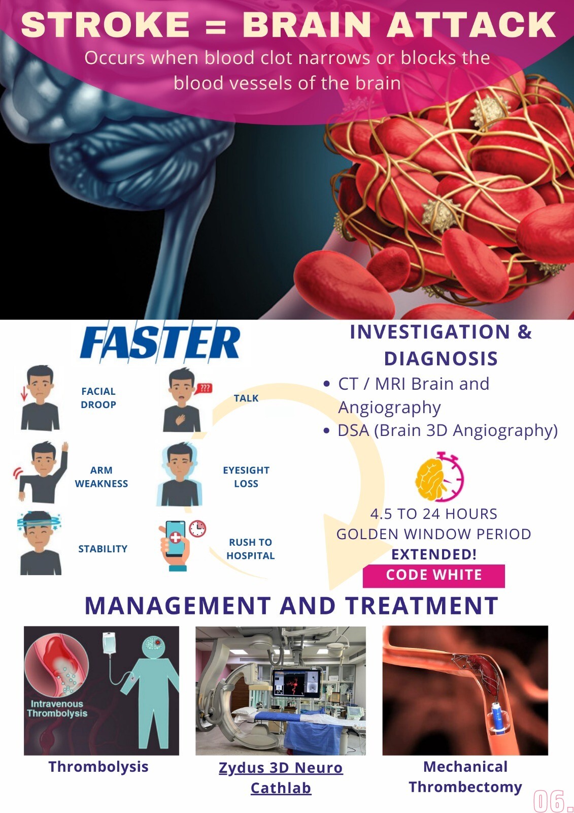 Stroke Symptoms Treatment Center In Ahmedabad Udaipur Bhilwara 
