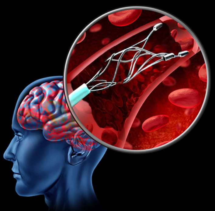 stenting symtoms