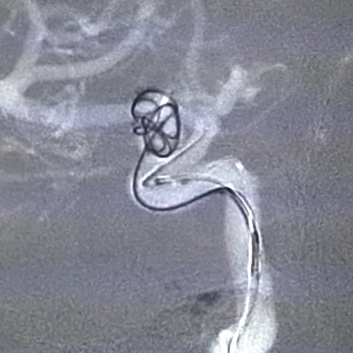 Coiling-Aneurysm-video-bg